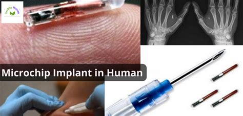 Microchip implant (human) 